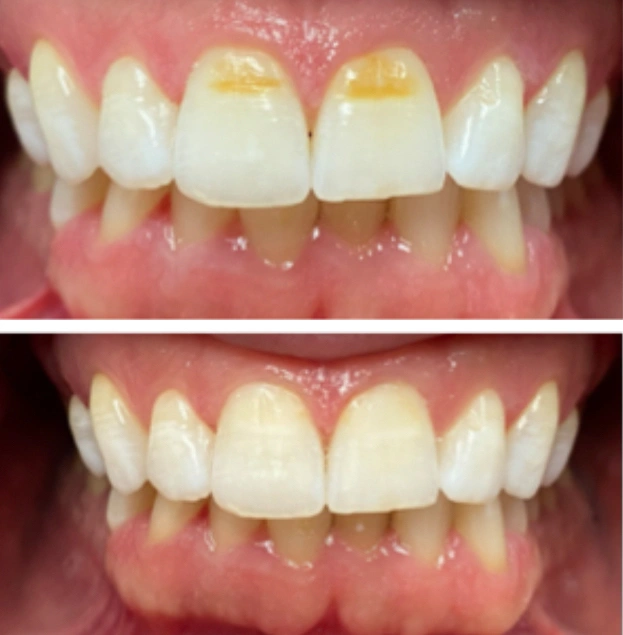 Before and after dental treatment showing improved tooth alignment and whitening on front upper and lower teeth.