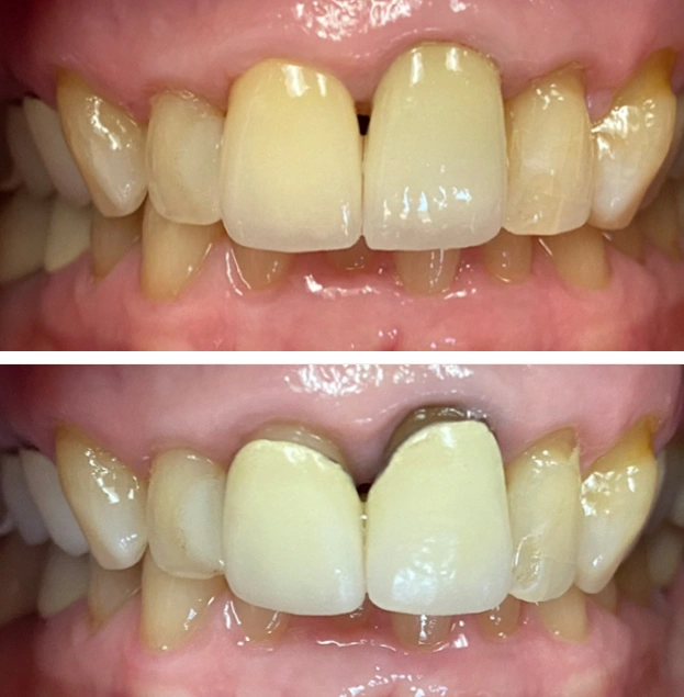 Before and after dental crowns showing improved tooth color and shape on central incisors.