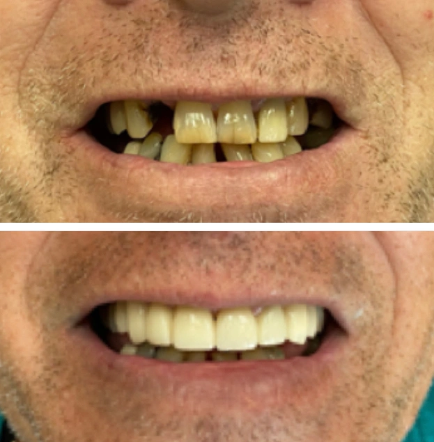 Before and after dental treatment showing improved tooth alignment and whitening results.