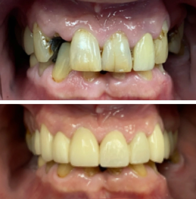 Before and after dental restoration showing improved tooth alignment and appearance.