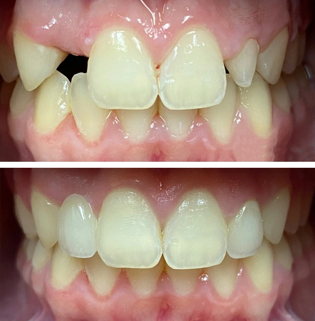 Before and after dental restoration showing improved tooth alignment and appearance of upper front teeth.