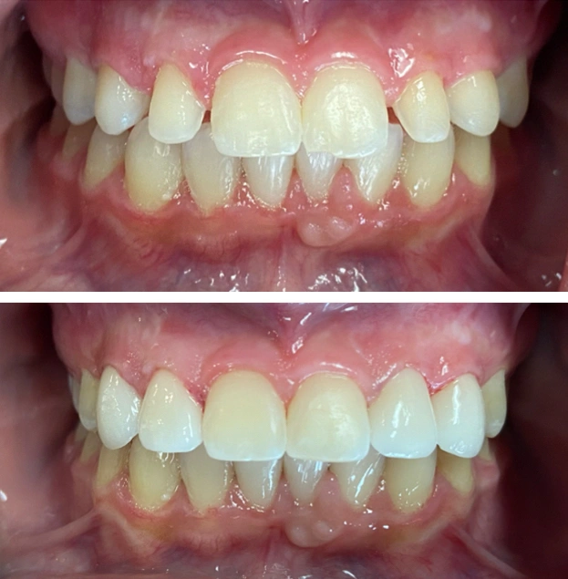 Before and after dental veneers showing improved tooth alignment and whiteness.