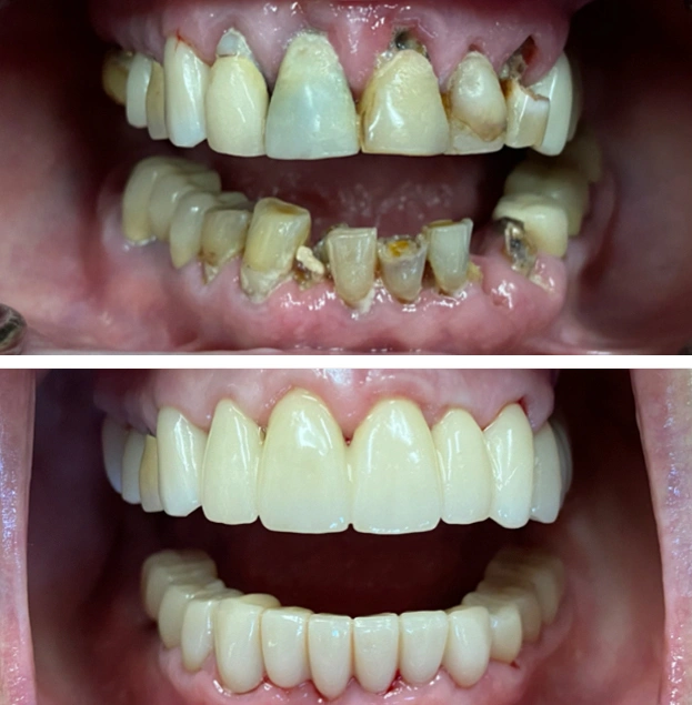Before and after dental restoration showing improved tooth alignment and appearance.