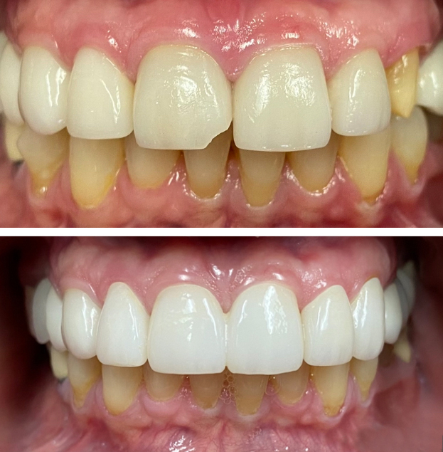 Before and after dental veneers transformation showing improved tooth color, shape, and alignment.