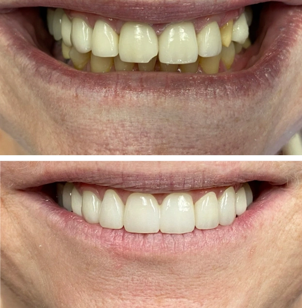 Before and after dental comparison showing improved teeth whitening and alignment results.