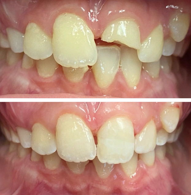 Before and after dental restoration showing improved tooth alignment and spacing in anterior teeth.