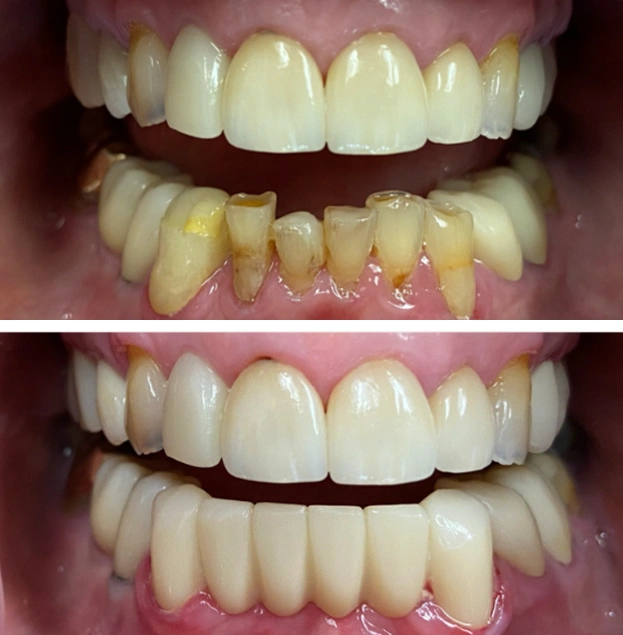 Before and after dental restoration showing improved tooth color and alignment through professional treatment.