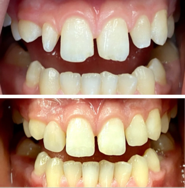 Before and after dental whitening treatment showing tooth color improvement from yellow to bright white.