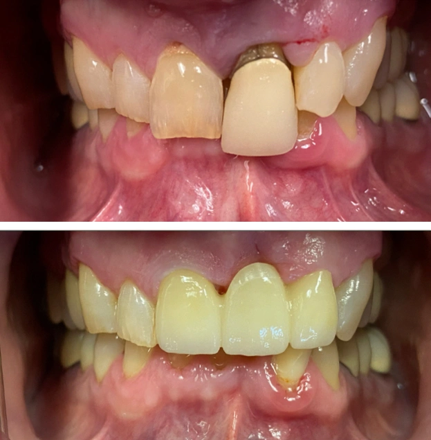 Before and after dental restoration showing improved tooth color and alignment in upper front teeth.