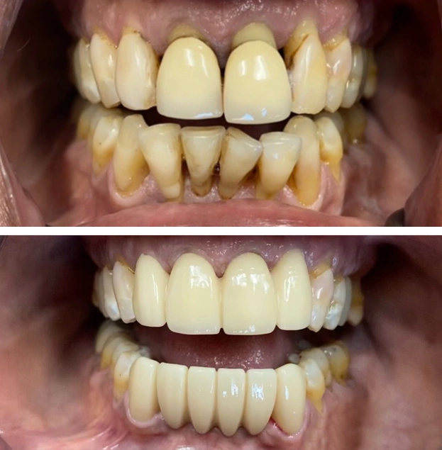 Before and after dental restoration showing improved tooth alignment and brightness at Gold Coast Family Dental.