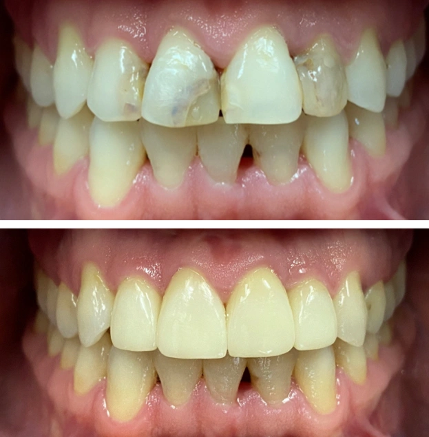 Before and after dental restoration showing improved tooth alignment and whiteness at Gold Coast Family Dental.