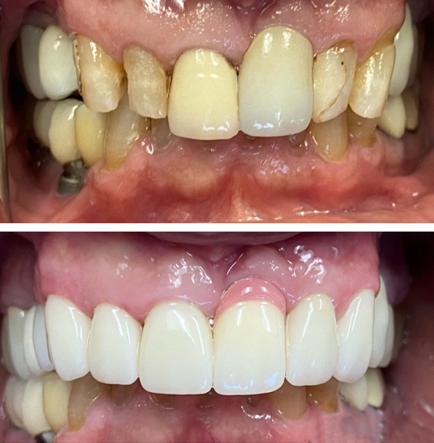 Before and after dental treatment showing tooth restoration and whitening results at Gold Coast Family Dental.