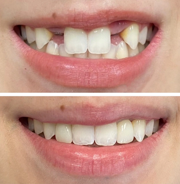 Before and after dental treatment showing improved tooth alignment and whiteness.