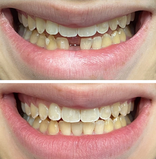 Before and after dental treatment showing improved tooth alignment and whitening results.