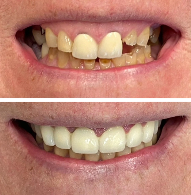 Before and after dental treatment showing improved tooth alignment and whiteness at Gold Coast Family Dental.