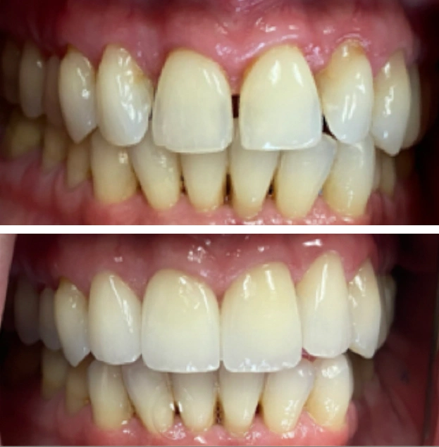 Before and after dental veneers showing improved tooth alignment and whitening results.