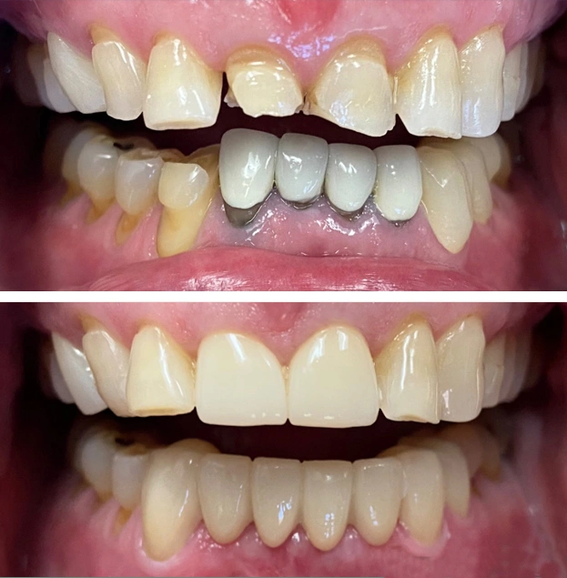 Before and after dental restoration showing improved tooth alignment and whiteness.