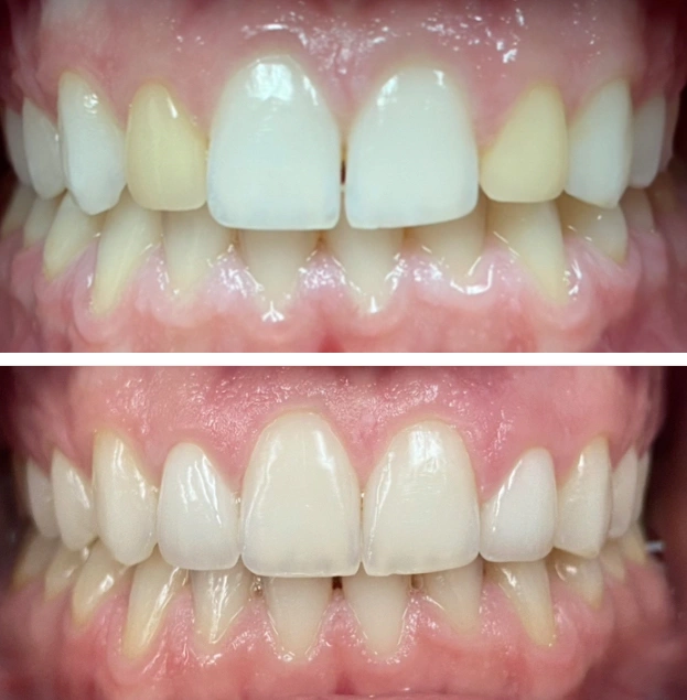 Before and after dental treatment showing improved tooth whiteness and alignment at Gold Coast Family Dental.
