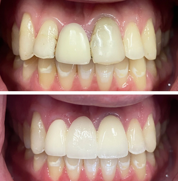 Before and after dental veneers showing improved tooth alignment and whiteness.