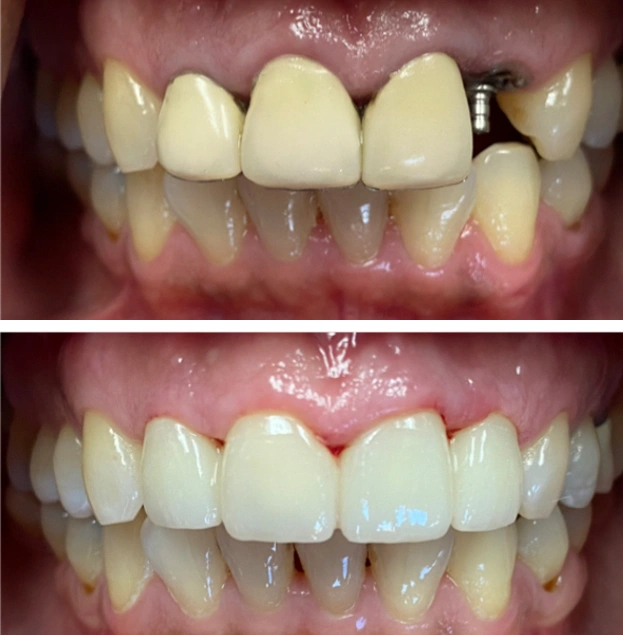 Before and after dental restoration showing improved tooth alignment and whiteness from cosmetic dentistry treatment.