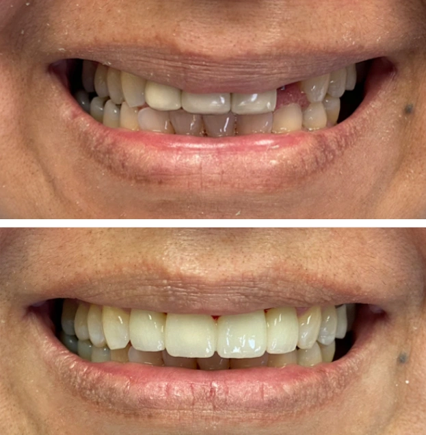 Before and after dental treatment comparison showing improved tooth alignment and whiteness.