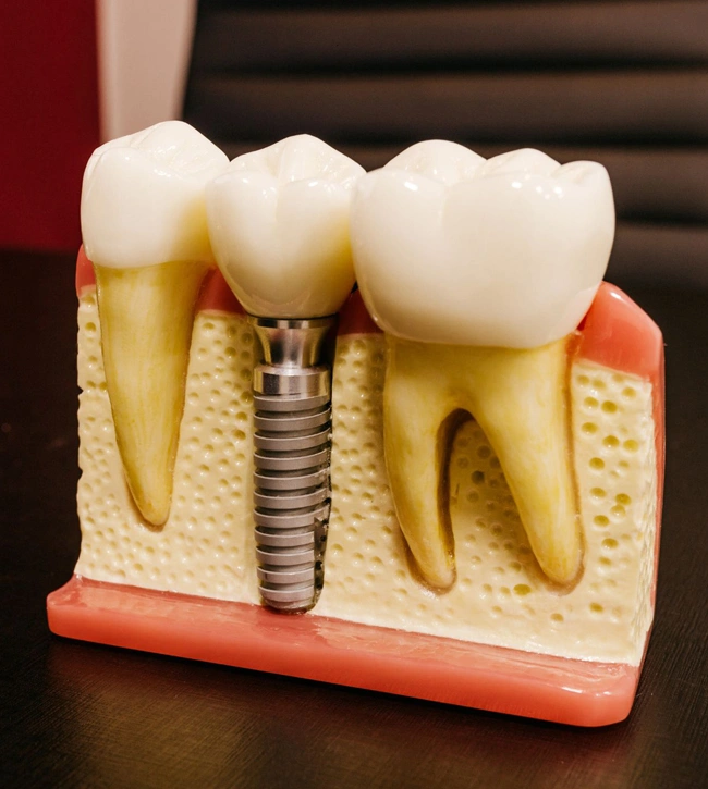 Dental implant model showing tooth, implant fixture, and crown on anatomical jaw base.