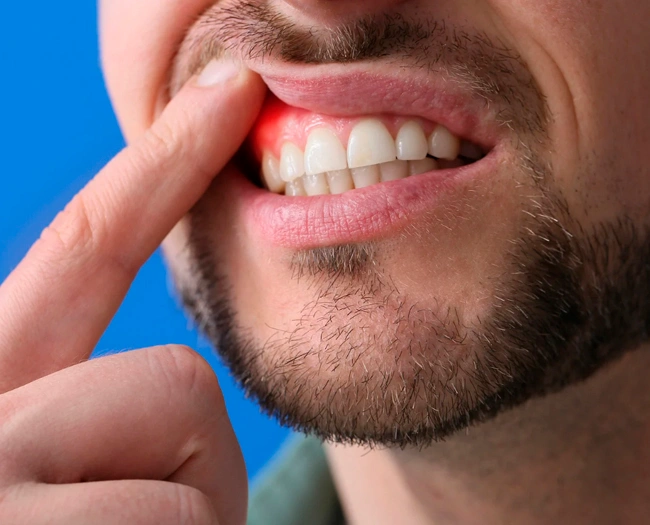 Man pointing to inflamed red gum area, showing gum disease or dental problem against blue background.