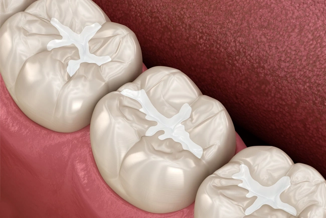Three white dental crowns with occlusal surface details on pink gum tissue model.