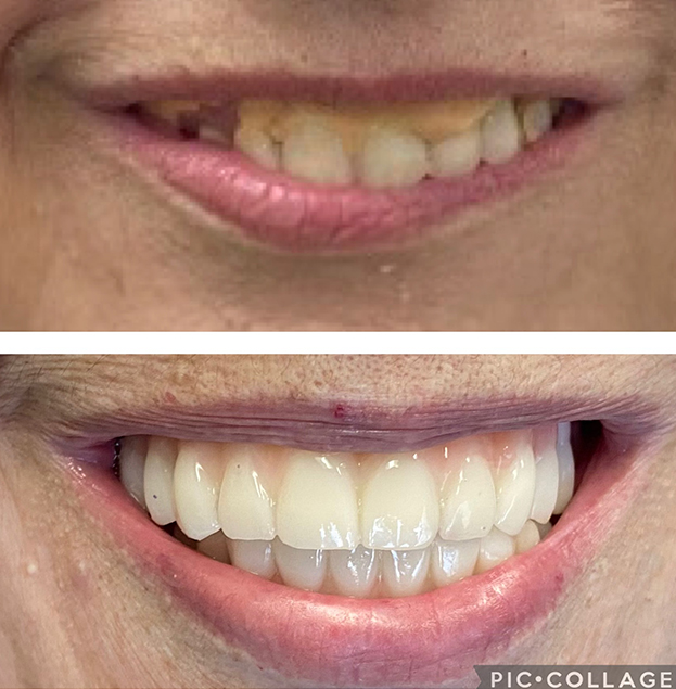 Before and after dental treatment showing smile transformation with whitened, aligned teeth.