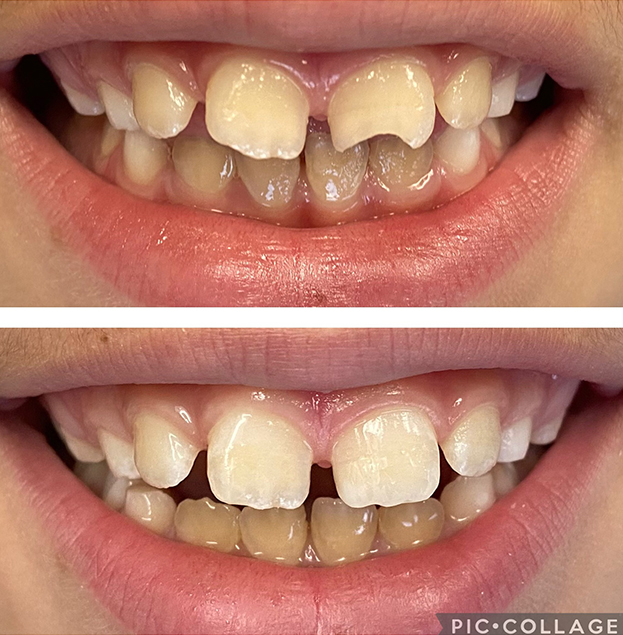 Before and after dental treatment showing improved tooth alignment and whiteness at Gold Coast Family Dental.