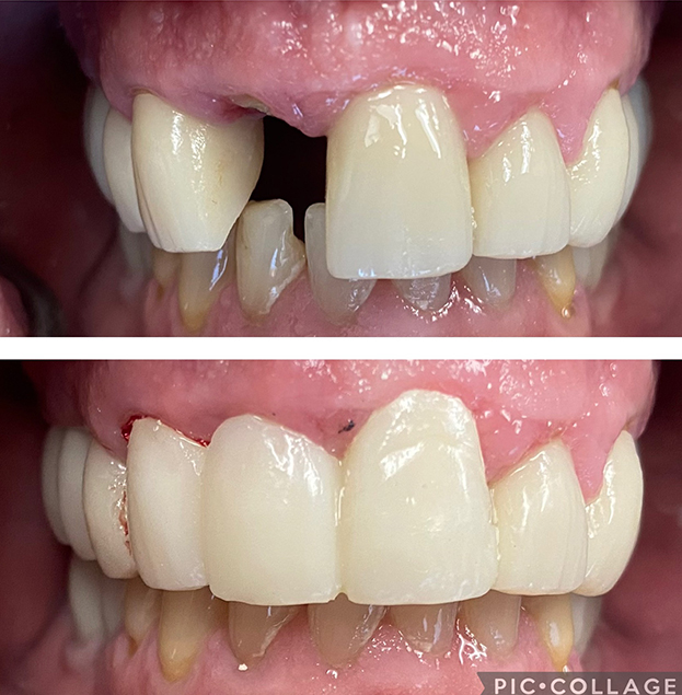 Before and after dental restoration showing missing front tooth replaced with bridge prosthetic.