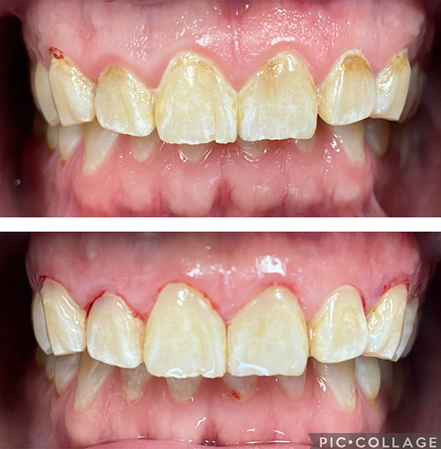 Before and after dental veneer treatment showing improved tooth appearance and alignment.