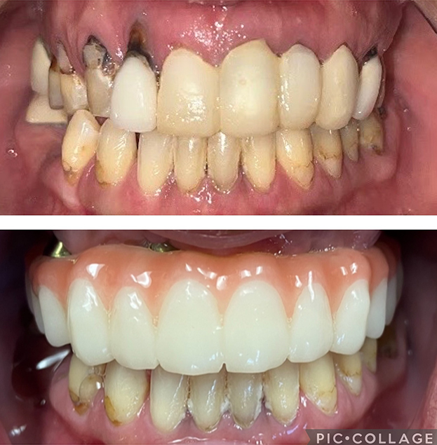 Before and after dental restoration showing discolored natural teeth transformed into bright white prosthetic teeth.