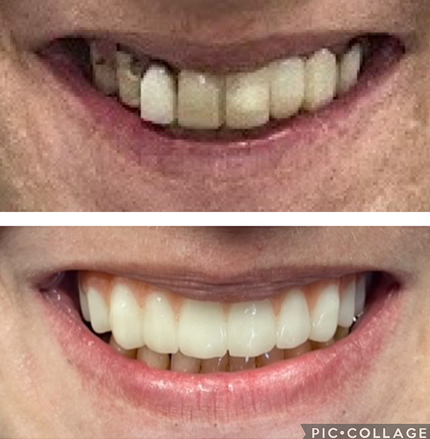 Before and after dental transformation showing improved tooth alignment and brightness from cosmetic dentistry treatment.