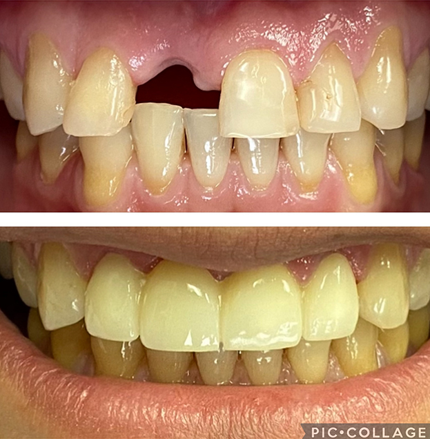 Before and after dental crowns restoration showing improved tooth appearance and alignment.