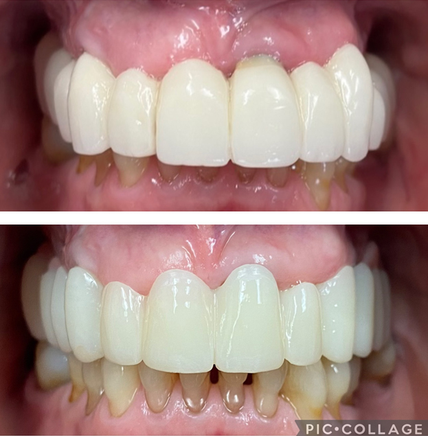Before and after dental restoration showing upper and lower teeth with white crowns or veneers.