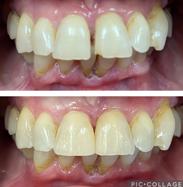 Before and after dental veneers showing improved tooth shape and alignment on upper front teeth.