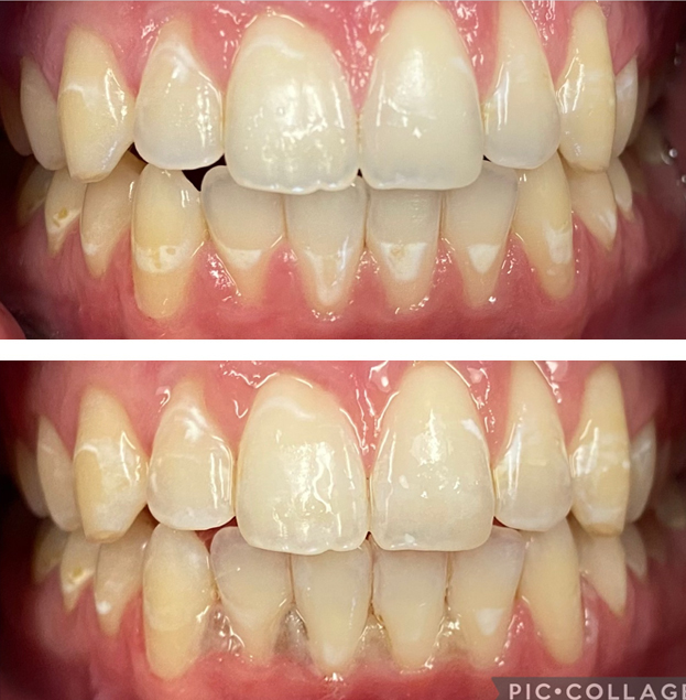 Before and after dental veneers showing whitened front teeth restoration by Gold Coast Family Dental.