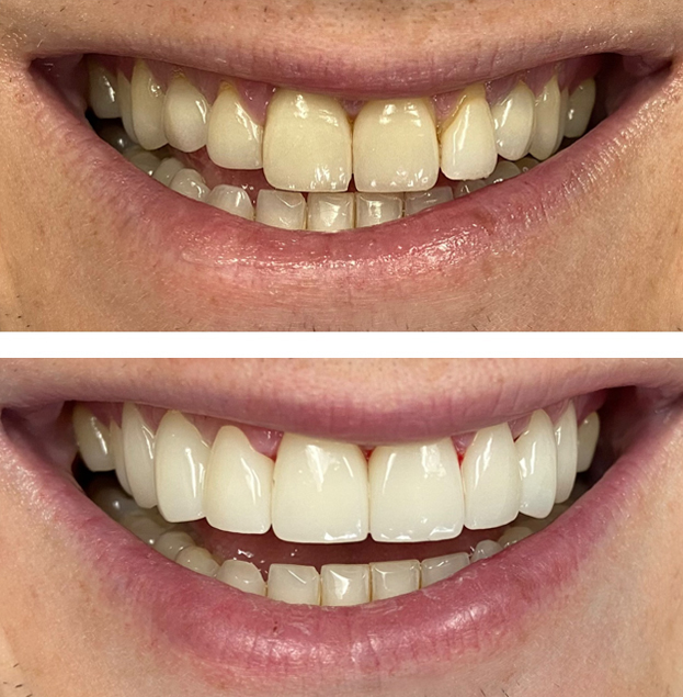 Before and after dental treatment showing improved tooth alignment and whiteness.