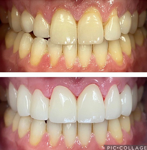 Before and after dental whitening comparison showing yellowed teeth transformed to bright white smile.