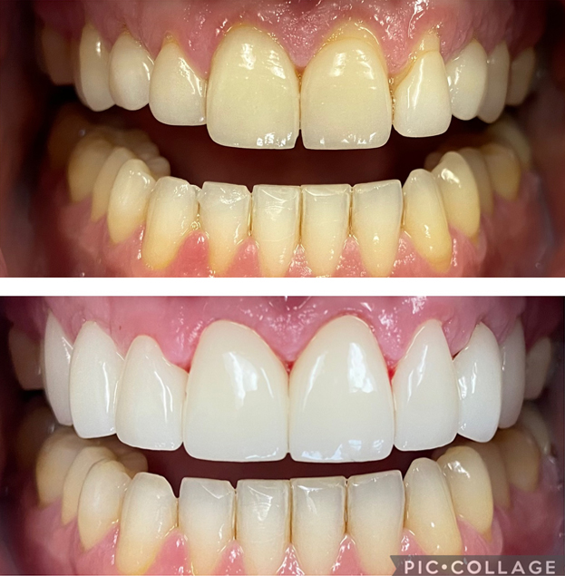 Before and after dental veneers: yellowed teeth transformed to bright white smile.