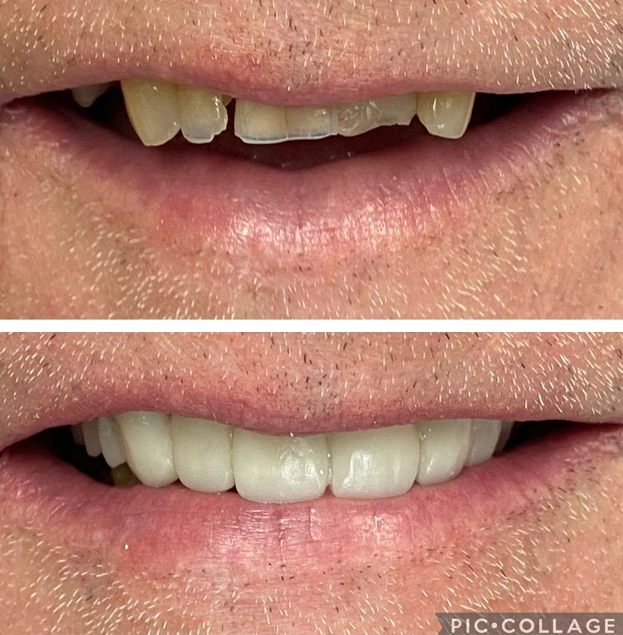 Before and after dental restoration showing improved tooth alignment and appearance.