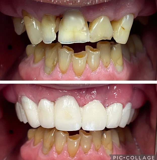 Before and after dental restoration: discolored, damaged teeth transformed to bright, uniform white veneers.