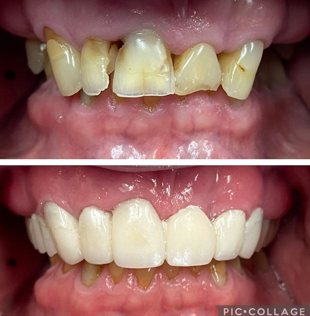 Before and after dental restoration showing tooth whitening and cosmetic bonding treatment results.