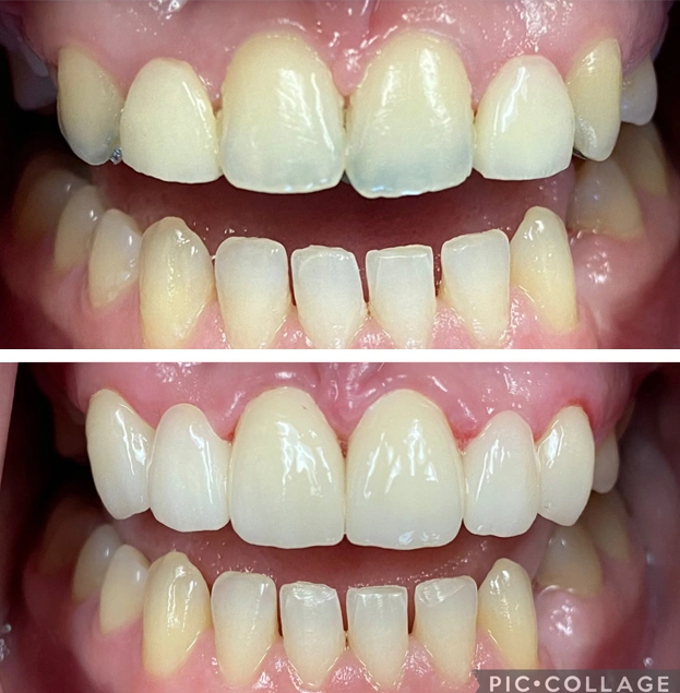Before and after dental restoration showing improved tooth alignment and whiteness comparison.