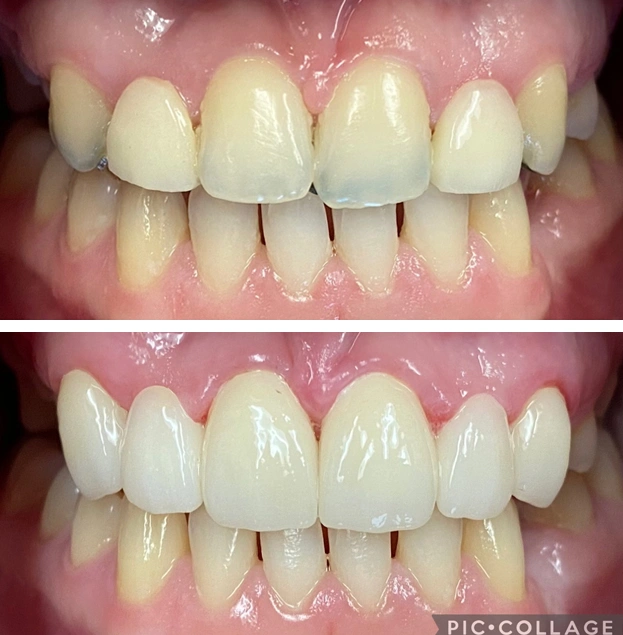 Before and after dental restoration showing improved tooth alignment and whiteness.
