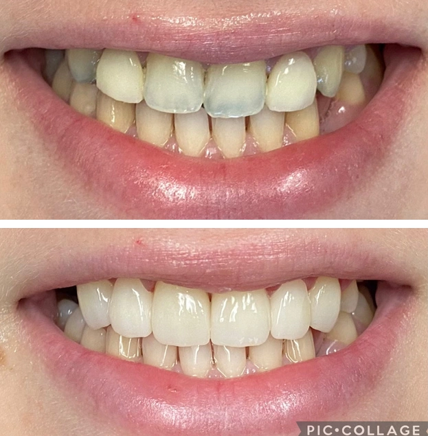 Before and after dental treatment showing improved tooth alignment and whitening results.