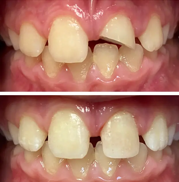 Before and after dental restoration showing improved tooth alignment and appearance at Gold Coast Family Dental.