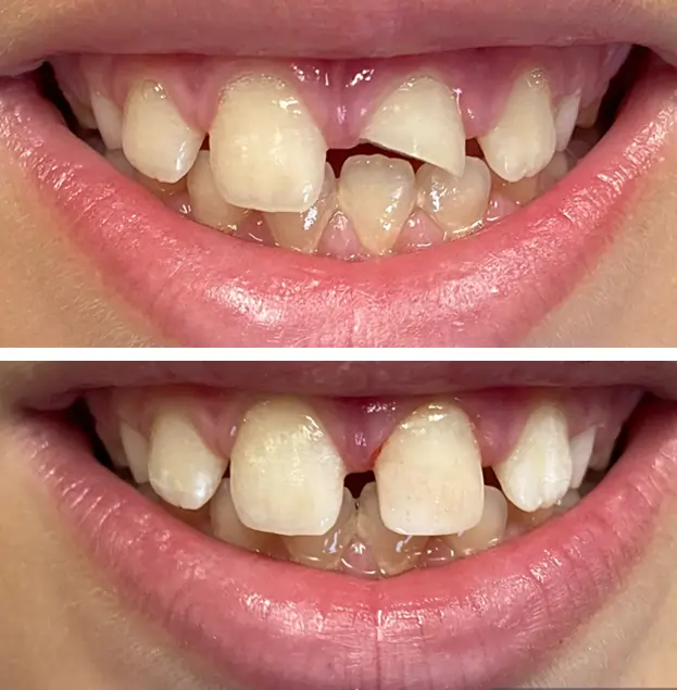Before and after dental restoration showing improved tooth alignment and appearance.