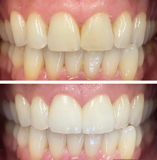 Before and after dental restoration showing improved tooth whiteness and alignment on natural teeth.